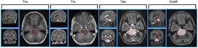 Multimodal MRI radiomic models to predict genomic mutations in diffuse intrinsic pontine glioma with missing imaging modalities